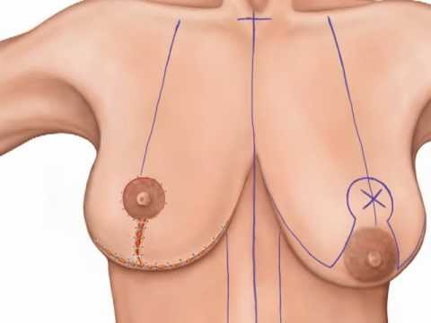 Breasts: Bilateral Mastopexy
